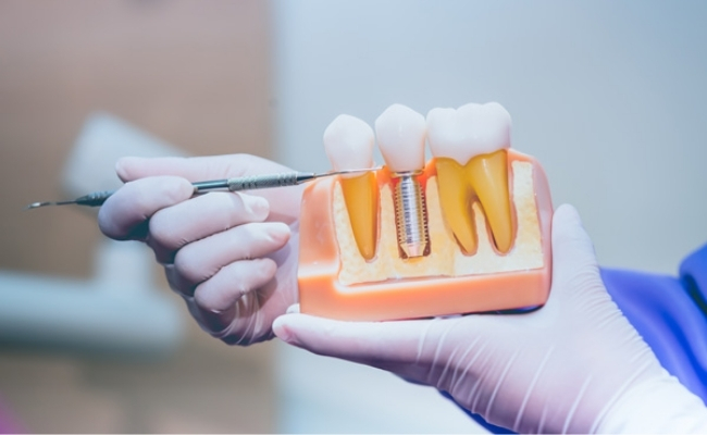 Dental-Implants-30.jpg