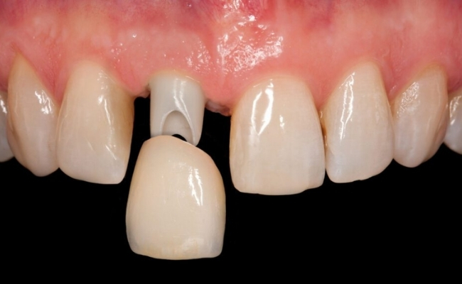 Dental Crowns