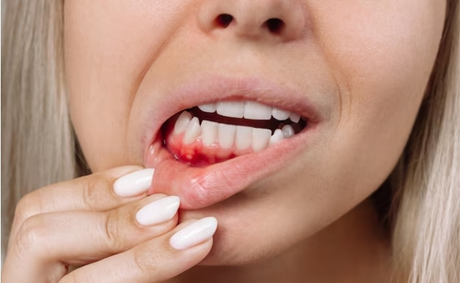 Gum-Disease-Treatment