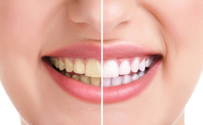 Teeth-Whitening-30.jpg