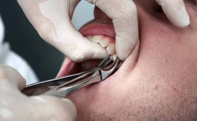 Tooth-Extractions-